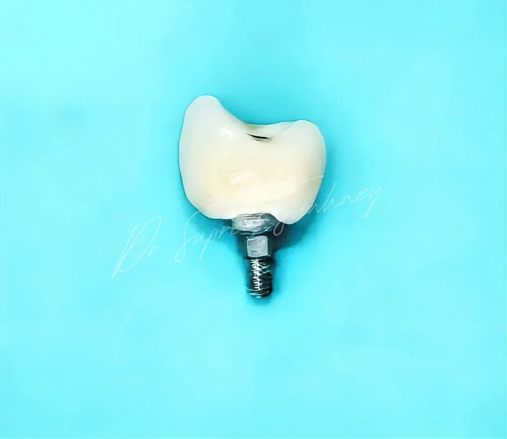 Single-tooth implant crown with abutment on a blue clinical background